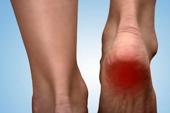 Fasciitis plantaris of hielspoor: een continue kwelling